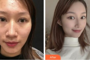 上?？祳W醫(yī)療美容醫(yī)院趙華整形價格表附微針祛痘案例展示