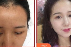 上?？祳W醫(yī)療美容醫(yī)院白俊杰整形價格表附發(fā)際線種植案例展示