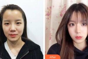 上?？祳W醫(yī)療美容醫(yī)院錢麟整形價格表附美鼻部手術(shù)案例展示