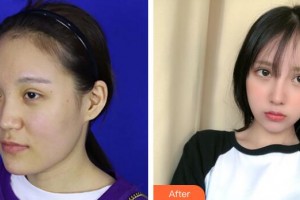 珠海華澳醫(yī)療美容整形門診部鄧強(qiáng)整形價格表附鼻部手術(shù)案例展示