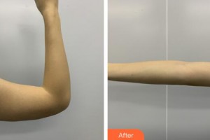 廣州美萊醫(yī)療美容醫(yī)院徐宇紅整形價格表附手臂吸脂案例展示