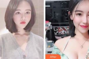 廣州軍美整形醫(yī)院肖強(qiáng)整形價格表附高端定制假體美胸案例展示