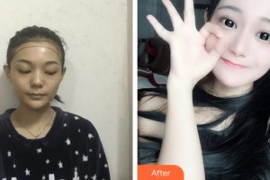 上海宏康醫(yī)院整形美容中心張會堂 教授整形價格表附種植發(fā)際線案例展示