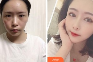 上海宏康醫(yī)院整形美容中心張華整形價格表附桃花眼部手術(shù)案例展示