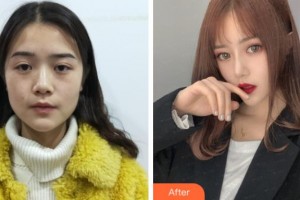 上海玫瑰醫(yī)療美容醫(yī)院黃國全 整形價格表附假體隆鼻案例展示