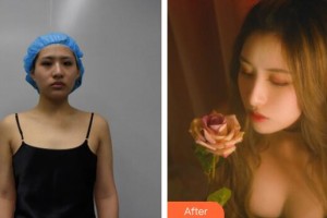 廣州美萊醫(yī)療美容醫(yī)院劉永波整形價格表附脂肪填充胸部案例展示