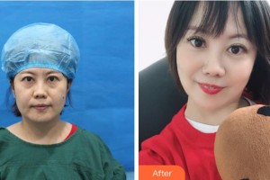 黑龍江省人民醫(yī)院整形美容中心冉維志整形價(jià)格表附不開(kāi)刀祛眼袋+自體脂肪填充淚案例展示