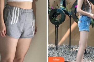 上海華美美萊美容醫(yī)院夏國興整形價格表附大腿吸脂案例展示