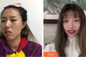 上海玫瑰醫(yī)療美容醫(yī)院韓素萍 整形價格表附色斑痘印暗黃出油皺紋案例展示