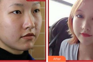 上海玫瑰醫(yī)療美容醫(yī)院金振口整形價格表附Park法復式切開雙眼皮案例展示