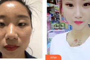 武警上?？傟?duì)醫(yī)院整形美容中心曹慧整形價(jià)格表附激光祛斑美白肌膚案例展示