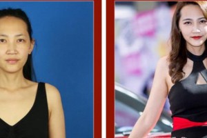 武警上海總隊(duì)醫(yī)院整形美容中心王慕 整形價(jià)格表附自體脂肪隆胸案例展示