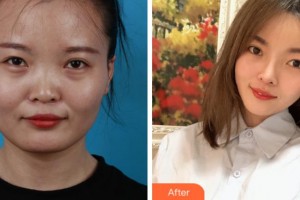 上海美之源整形外科醫(yī)院周曉東整形價(jià)格表附臉型（顴骨+下頜角）+鼻部手術(shù)案例展示