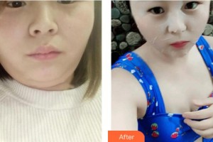 上海美之源整形外科醫(yī)院李月輝整形價(jià)格表附光子嫩膚案例展示