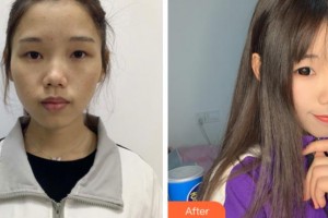 上海閔行區(qū)中醫(yī)院整形外科閆學(xué)敏整形價(jià)格表附超激光美膚案例展示