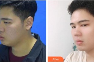 上海富華醫(yī)療美容醫(yī)院候澤民整形價(jià)格表附縮脂針案例展示