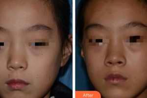 廣州軍頤醫(yī)院整形美容中心曾晶圓整形價格表附激光點(diǎn)痣案例展示