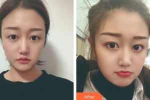 南方醫(yī)科大學(xué)附屬廣州燕嶺醫(yī)院整形美容中心雷濤整形價格表附埋線雙眼皮案例展示