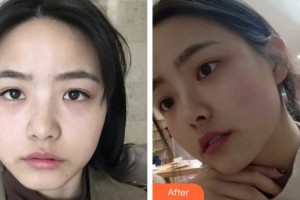 上海港華醫(yī)療美容醫(yī)院季薏整形價格表附超激光美膚祛雀斑曬斑案例展示