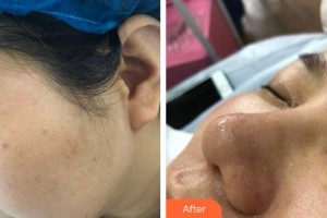 上海瑞麗整形美容醫(yī)院白容官整形價格表附果酸祛角質(zhì)、黑頭、粉刺雞、皮膚案例展示