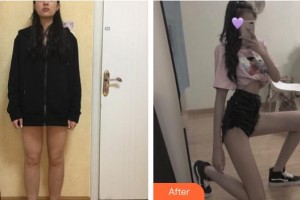 上海韓仕醫(yī)療美容門診部沈鶯鶯整形價格表附大腿吸脂案例展示