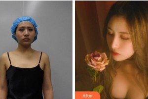 上海黃興醫(yī)院整形外科張墨林整形價格表附脂肪填充胸部案例展示