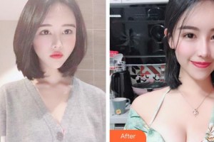 上海美侖醫(yī)療美容門診部于彬整形價格表附高端假體復(fù)合隆胸案例展示