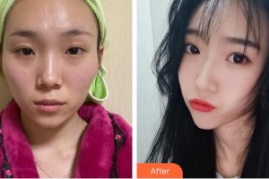 上海韓春民整形外科診所韓春民整形價格表附顴骨內(nèi)推案例展示