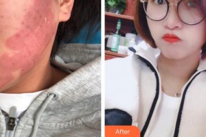 上海新星醫(yī)療美容整形外科楊紅華整形價格表附點(diǎn)陣祛痘坑痘印案例展示