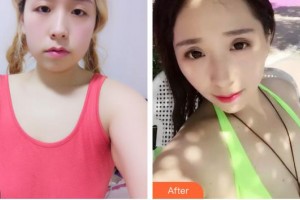 民航上海醫(yī)院整形外科俞良鋼整形價(jià)格表附假體隆胸整形案例展示