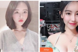 上海申江醫(yī)院整形美容科叢菊芝整形價(jià)格表附高端假體隆胸案例展示