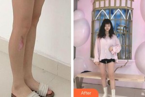 上海交通大學(xué)附屬瑞金醫(yī)院燒傷整形科廖鎮(zhèn)江整形價(jià)格表附祛疤痕-激光祛疤案例展示