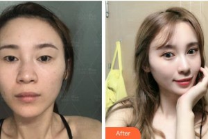 上?，旣愥t(yī)院整形美容中心謝宏德整形價格表附切開雙眼皮案例展示