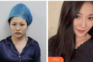 上海新極點(diǎn)醫(yī)療美容診所戴紅整形價格表附黃金微雕全臉案例展示