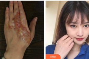 上海交通大學(xué)附屬瑞金醫(yī)院燒傷整形科方培耀整形價(jià)格表附燙傷疤痕案例展示