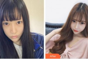 上海市第一人民醫(yī)院整形外科賈萬(wàn)新整形價(jià)格表附面部吸脂案例展示