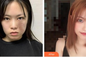 上海宸妃醫(yī)學(xué)美容醫(yī)院徐永成整形價(jià)格表附燙傷疤痕案例展示