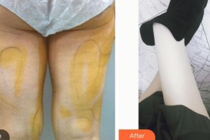 上海第八人民醫(yī)院美容整形科黃杰整形價(jià)格表附吸脂案例展示