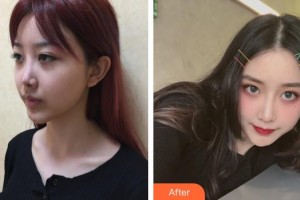 上海伊美爾港華醫(yī)療美容醫(yī)院師麗麗整形價(jià)格表附隆鼻案例展示