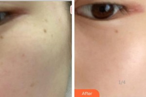 海軍上海保障基地醫(yī)院激光整形美容中心呂丹整形價(jià)格表附美白祛斑案例展示