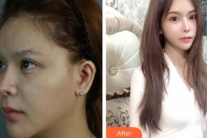 上海伊萊美醫(yī)療美容醫(yī)院王世專整形價(jià)格表附顴骨顴弓降低案例展示