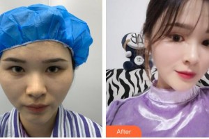 上海時(shí)光整形外科醫(yī)院李靜林整形價(jià)格表附鼻部手術(shù)案例展示