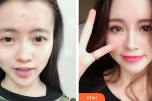 上海伯思立醫(yī)療美容門診部徐曉斐整形價(jià)格表附隆鼻案例展示