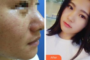 上海鵬愛醫(yī)療美容門診部李惠娟整形價(jià)格表附點(diǎn)陣激光祛痘案例展示