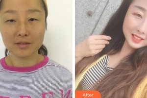 上海華美醫(yī)療美容醫(yī)院武崇高整形價(jià)格表附祛眼袋案例展示