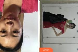 上海第八人民醫(yī)院美容整形科陳煒整形價(jià)格表附隆鼻案例展示