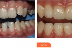 上海伊美爾港華醫(yī)療美容醫(yī)院楚明整形價(jià)格表附牙齒矯正案例展示