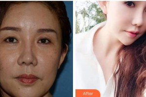 上海原辰醫(yī)療美容醫(yī)院黃仁錫整形價(jià)格表附眼部整形案例展示