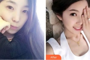 上海常亮醫(yī)療美容診所蔣春梅整形價(jià)格表附提眉術(shù)案例展示