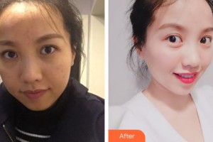 上海薇凱醫(yī)療美容門診部高岱琪整形價格表附色斑痘印暗黃出油皺紋案例展示